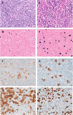 Case report: XMEN disease: a patient with recurrent Hodgkin lymphoma and immune thrombocytopenia